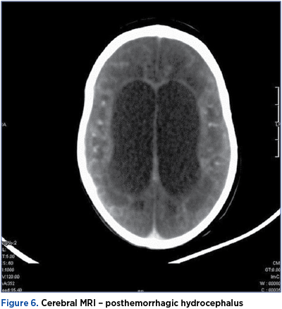 Figure 6. Cerebral MRI – posthemorrhagic hydrocephalus 
