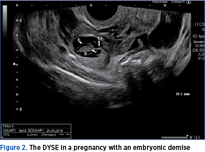 Figure 2. The DYSE in a pregnancy with an embryonic demise