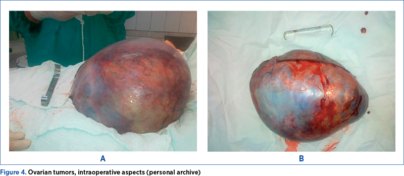 Figure 4. Ovarian tumors, intraoperative aspects (personal archive)