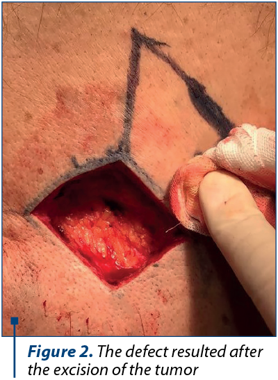 Figure 2. The defect resulted after the excision of the tumor