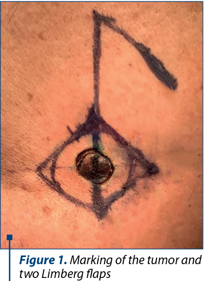 Figure 1. Marking of the tumor and two Limberg flaps
