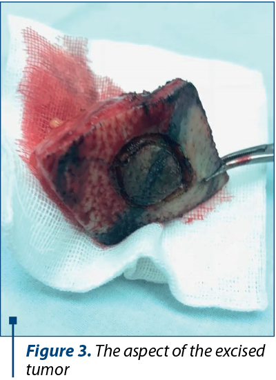 Figure 3. The aspect of the excised tumor