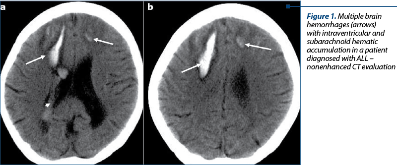 Figure 1. Multiple brain hemorrhages (arrows) with intraventricular and subarachnoid hematic accumulation in a patient diagnosed with ALL – nonenhanced CT evaluation