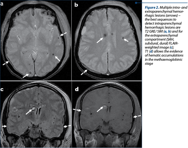 Figure 2. Multiple intra- and extraparenchymal hemor­rhagic lesions (arrows) –  the best sequences to detect intraparenchymal hemorrhagic lesions are T2 GRE/ SWI (a, b) and for the extraparenchymal compartment (SAH, subdural, dural) FLAIR-weighted image (c);  T1 (d) allows the evidence of hematic accumu­la­tions in the methaemoglobinic stage