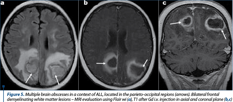 Figure 5. Multiple brain abscesses in a context of ALL, located in the parieto-occipital regions (arrows). Bilateral frontal demyelinating white matter lesions – MRI evaluation using Flair wi (a), T1 after Gd i.v. injection in axial and coronal plane (b,c)