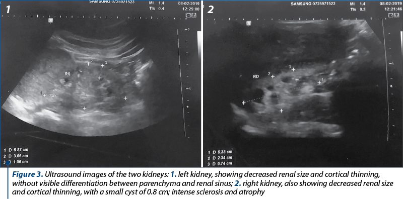 Figure 3. Ultrasound images of the two kidneys: 1. left kidney, showing decreased renal size and cortical thinning, without visible differentiation between parenchyma and renal sinus; 2. right kidney, also showing decreased renal size and cortical thinning, with a small cyst of 0.8 cm; intense sclerosis and atrophy