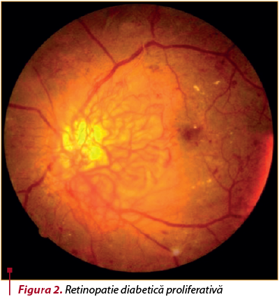 vedere după retinopatie