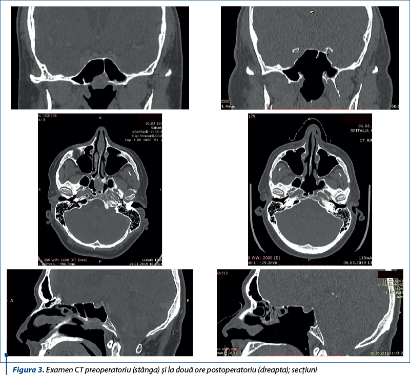 Figura 3. Examen CT preoperatoriu (stânga) şi la două ore postoperatoriu (dreapta); secţiuni 