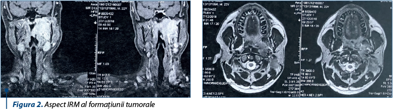 Figura 2. Aspect IRM al formaţiunii tumorale