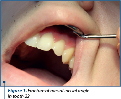Figure 1. Fracture of mesial incisal angle 