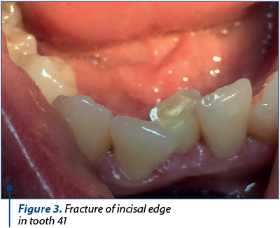 Figure 3. Fracture of incisal edge 