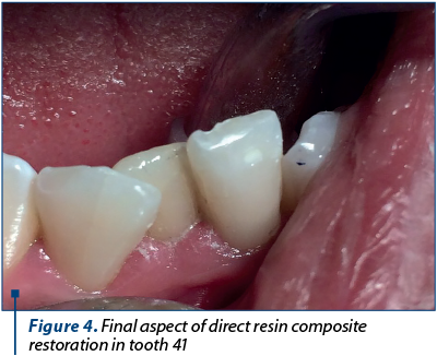 Figure 4. Final aspect of direct resin composite restoration in tooth 41