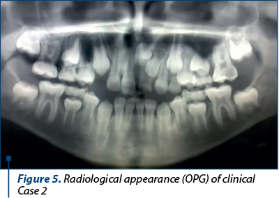 Figure 5. Radiological appearance (OPG) of clinical Case 2