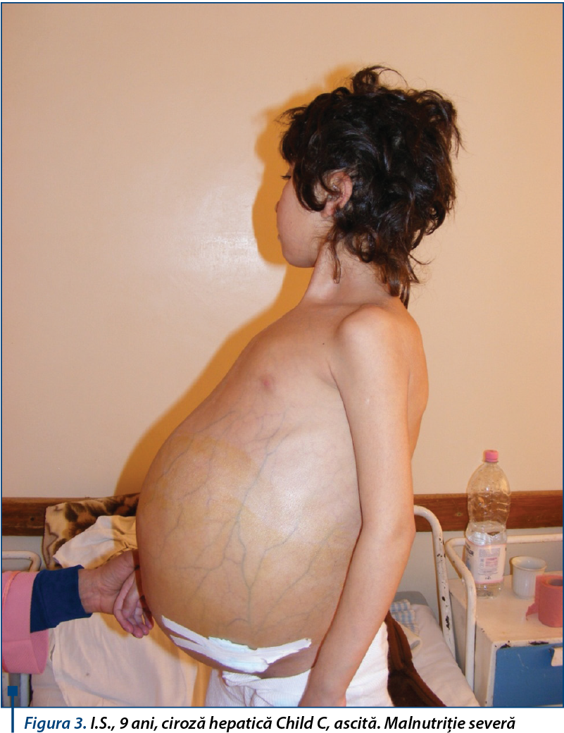 I.S., 9 ani, ciroză hepatică Child C, ascită. Malnutriție severă