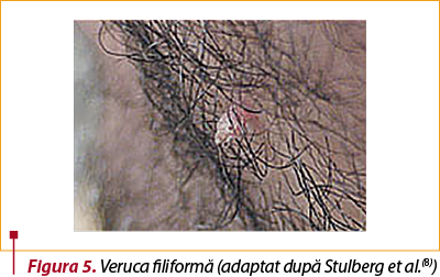 Figura 5. Veruca filiformă (adaptat după Stulberg et al.(8))