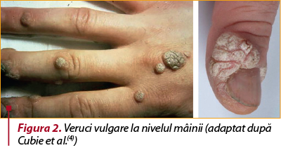 Figura 2. Veruci vulgare la nivelul mâinii (adaptat după Cubie et al.(4))