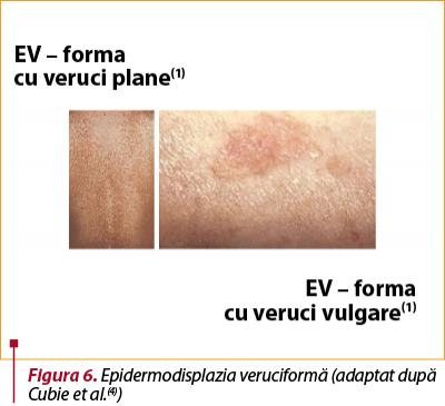 Figura 6. Epidermodisplazia veruciformă (adaptat după Cubie et al.(4))