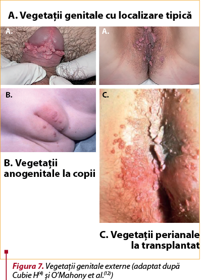 Figura 7. Vegetaţii genitale externe (adaptat după Cubie H(4) şi O’Mahony et al.(12))
