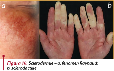 Sclerodermia: simptome, tratament