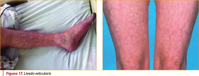 Manifestări Dermatologice In Bolile Reumatologice