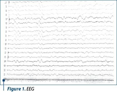 Figure 1. EEG
