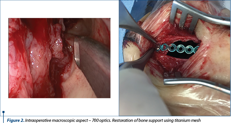Figure 2. Intraoperative macroscopic aspect – 700 optics. Restoration of bone support using titanium mesh