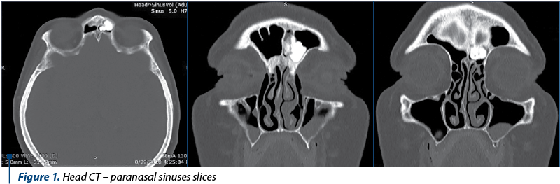 Figure 1. Head CT – paranasal sinuses slices