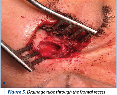 Figure 5. Drainage tube through the frontal recess