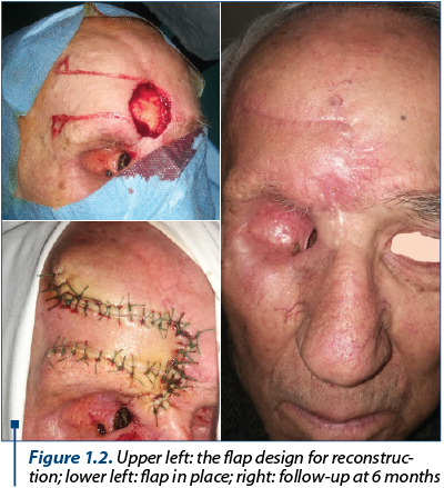 Figure 1.2. Upper left: the flap design for recons­truc­tion; lower left: flap in place; right: follow-up at 6 months 