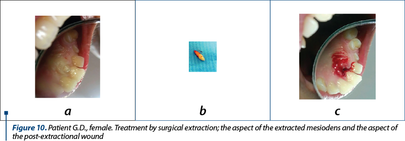 Figure 10. Patient G.D., female. Treatment by surgical extraction; the aspect of the extracted mesiodens and the aspect of the post-extractional wound  