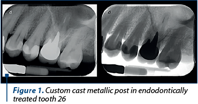 Figure 1. Custom cast metallic post in endodontically treated tooth 26