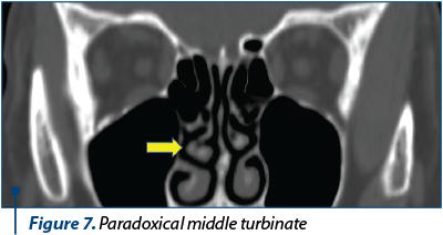 Figure 7. Paradoxical middle turbinate