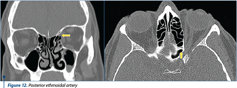 Figure 12. Posterior ethmoidal artery