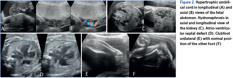 Figure 2. Hypertrophic umbilical cord in longitudinal (A) and axial (B) views of the fetal abdomen. Hydronephrosis in axial and longitudinal view of the kidney (C). Atrio-ventricular septal defect (D). Clubfoot unilateral (E) with normal position of the other foot (F)