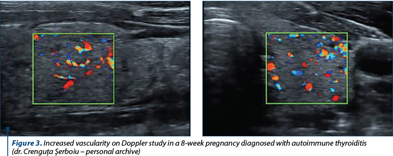 Figure 3. Increased vascularity on Doppler study in a 8-week pregnancy diagnosed with autoimmune thyroiditis  (dr. Crenguţa Şerboiu – personal archive)