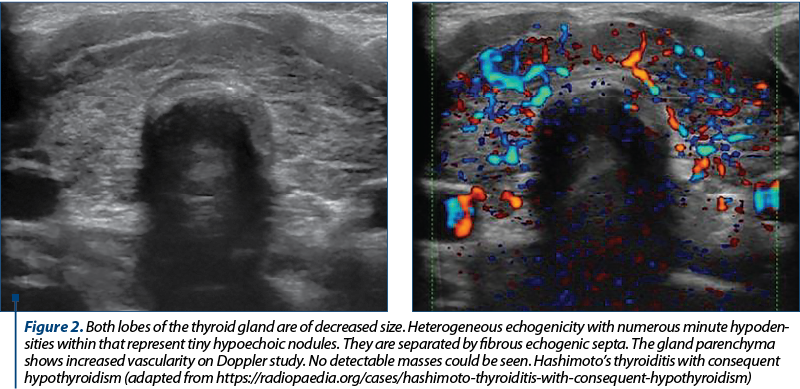 Figure 2. Both lobes of the thyroid gland are of decreased size. Heterogeneous echogenicity with numerous minute hypoden­si­ties within that represent tiny hypoechoic nodules. They are separated by fibrous echogenic septa. The gland parenchyma shows increased vascularity on Doppler study. No detectable masses could be seen. Hashimoto’s thyroiditis with consequent hypothyroidism (adapted from https://radiopaedia.org/cases/hashimoto-thyroiditis-with-consequent-hypothyroidism)
