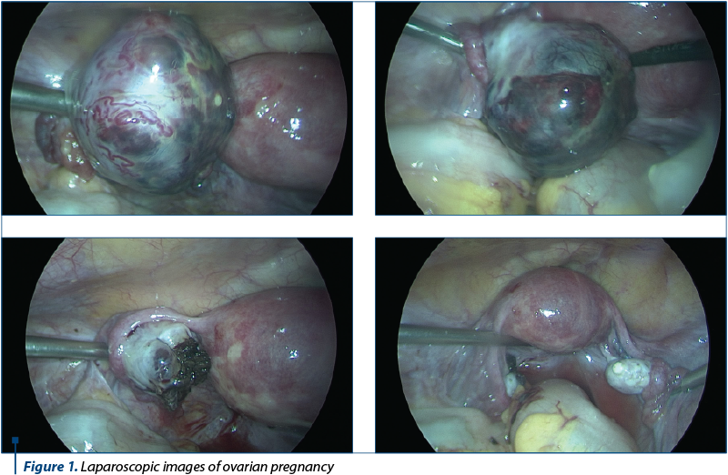 Figure 1. Laparoscopic images of ovarian pregnancy
