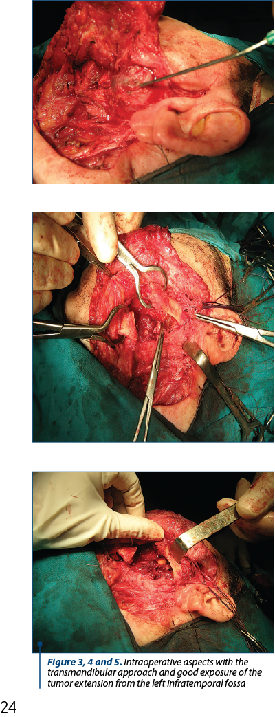 Figure 3, 4 and 5. Intraoperative aspects with the transmandibular approach and good exposure of the tumor extension from the left infratemporal fossa