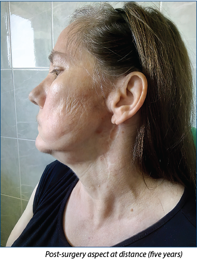Figure 6. Post-surgery aspect at distance (five years) 