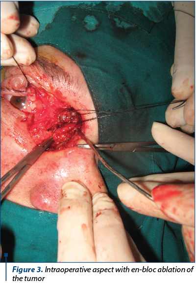 Figure 3. Intraoperative aspect with en-bloc ablation of the tumor