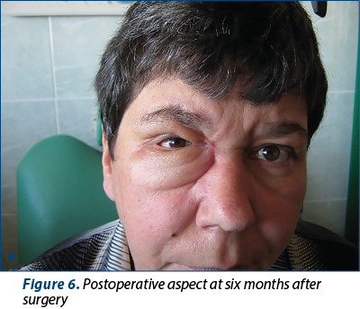 Figure 6. Postoperative aspect at six months after surgery
