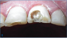 Figure 3. Glass fiber post cemented into the root canal in tooth 21