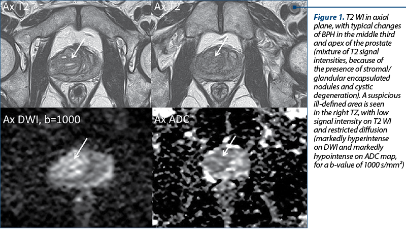 Figure 1. T2 WI in axial plane, with typical changes of BPH in the middle third and apex of the prostate (mixture of T2 signal intensities, because of the presence of stromal/glandular encapsulated nodules and cystic degeneration). A suspicious ill-defined area is seen in the right TZ, with low signal intensity on T2 WI and restricted diffusion (markedly hyperintense on DWI and markedly hypointense on ADC map, for a b-value of 1000 s/mm²)