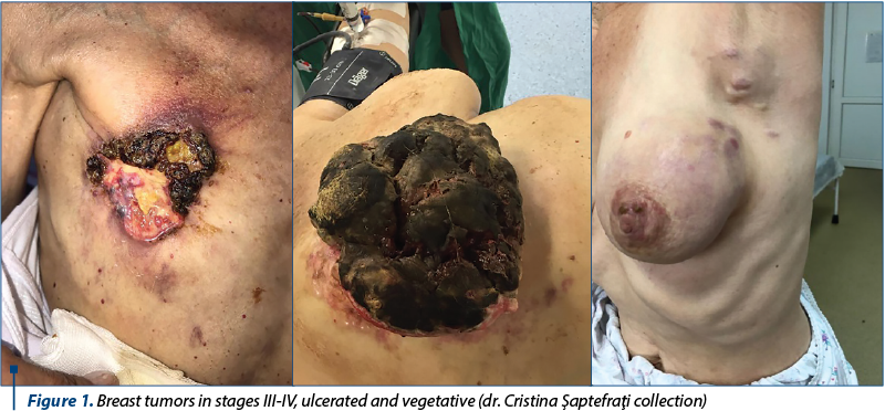Figure 1. Breast tumors in stages III-IV, ulcerated and vegetative (dr. Cristina Şaptefraţi collection) 