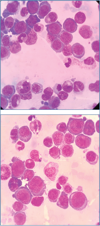 Figure 1. Groups of erythroblasts on bone marrow aspiration (MGG staining, X100)
