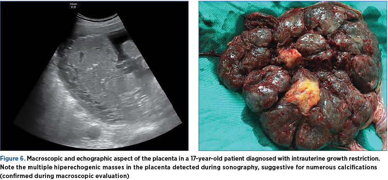 Figure 6. Macroscopic and echographic aspect of the placenta in a 17-year-old patient diagnosed with intrauterine growth restriction. Note the multiple hiperechogenic masses in the placenta detected during sonography, suggestive for numerous calcifications (confirmed during macroscopic evaluation)