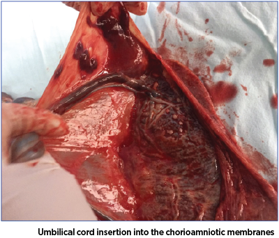 Figure 2. Umbilical cord insertion into the chorioamniotic membranes