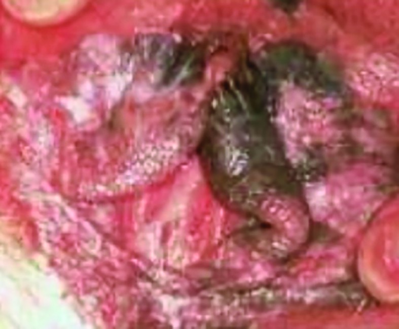 Aggressive undifferentiated carcinoma in the vagina — pic 15