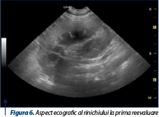 Figura 6. Aspect ecografic al rinichiului la prima reevaluare